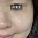 윤피부사랑 | [춘천기미케어] 윤이나다 : 색소 케어 2회차 솔직 후기 ✨