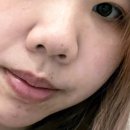라르펫 | 가짜코의 삶 1일차~7일차 (콧대 + 콧볼 지방제거/내 돈 내산)
