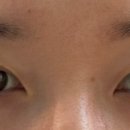 D-7 | ㅇㅁㄷ 자연유착+매몰 쌍수후기 D+7 (내돈내산)