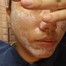 색소레이저 뉴아꼴레이드 ; 잡티제거레이저 일주일 후기