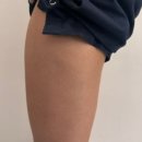 명동다이어트 성지에서 받은 허벅지 엠스컬프네오 다이어트주사 후기