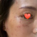 광주북구피부관리 각화동뷰티샵 편평사마귀 케어 H&amp;H '에이치앤에이치더바디'