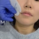 중앙부 | 강남역 피부과 엠페이스 중앙부 축소 후기 가져왔어요