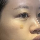 남포고운피부과의원 | 내돈내산 눈 옆 사마귀 레이저 제거 후기｜얼굴 사마귀 제거 비용 | 명동고운세상피부과