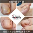 산본 레푸스 오블리네일에서 문제성발톱관리 1~5개월차 발톱관리 후기사진