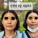 하남미사 인셀덤 호전반응(가성주름) 및 효과 50대엄마가 한달사용해본후기