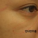 인디언주름필러 시술 후기 효과 통증유지기간 전부 정리