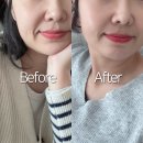 실루엣소프트 가격 아깝지 않았던 실루엣플리프팅 3개월 후기
