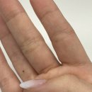 산본성심정형외과의원 | 손가락 결절종 수술 후기 (갱그리온 적출술)