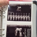 차오르다의원 | 임신일기 35주 36주차(정기검진, 임신중독증,제왕절개 출산)