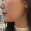 서면인모드 일주일후기 (이중턱 리프팅 광대 부산피부과 피부 관리)