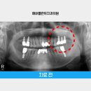 에버플란트치과의원 네이버블로그