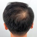 김포두피문신 구래동에서 직접 받아본 남자헤어라인 후기 썰!!