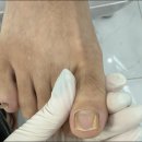 아트메디 | 군포 발톱무좀 때문에 방문한 풋네일 동성제약 풀리메디 관리 후기