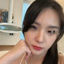레스틸렌 코필러 후기 (통증, 멍, 붓기, 술)