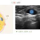 유피낭종 원인 및 증상 치료는 어떻게 해야 하는가 이미지