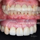 김동건바른치과의원 | 재치료 하는 방법? 잇몸이식을 동반한 재치료 과정 기간 가격 비용. 인천 부평 동암역 김동건바른치과