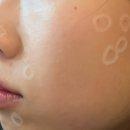 대덕대로220번길 | [대전피부과] 둔산동 밴스의원 방문후기, 점 제거