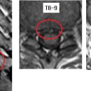 이글처럼 님의 흉추디스크 T8-9 황색인대비후증 T11-12의 MRI사진 판독입니다. 이미지