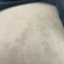 [안산 고잔동]피부과전문의 과잉진료없는 아토피치료 고잔동데이즈피부과의원(+광선치료후기 ing)