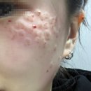 스위스의원 | [수원] 스위스의원 루비레이저 주근깨 제거 (시술과정, 가격)내돈내산