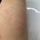 튼살 없애는법은 마고뷰티에서 레이저 시술 후기