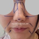 이중화비뇨기과 개방화장실 | 자가늑 무보형물 코성형 내돈내산 4편 | 수술 당일 후기 | 가격 | 전신마취 부작용