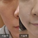 세이에너지 | [공지] 부산 모공치료 덕천동피부과 쿼드세이 내돈내산 후기