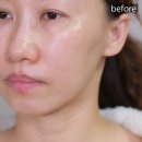 운정바이오 | 파주 운정 피부과 힐로웨이브 후기, 팔자 옆볼 패임 필러 대신 해봄