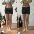 복부허벅지 지방분해주사 2주차 후기(변화가 조금씩 나타난다..!)