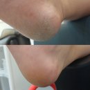 달곰네일 | 달곰네일 발각질·내성발톱 케어 후기