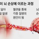 뇌까지 공격하는 관절 통증 … 방치하면 치매 일으킬수도 이미지