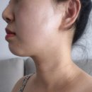 10년젊어지기(gb10) | 가로목주름에 트리필프로와 목주름주사로 구성된 자가진피재생술 2차후기