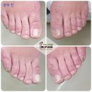 레푸스 수락산역점 | 서울 상계동 레푸스 수락산역점 노원 무좀발톱 관리