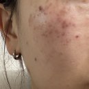압구정 루나의원 루비레이저 내돈내산 후기(한달 차 변화)