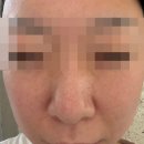 서울 중구 명동 포텐자 올클리닉에서 모공치료 찐 내돈내산 리얼후기