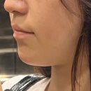 더웨이성형외과의원 | 이중턱윤곽주사 효과 한달 유지기간, 강남피부과 후기