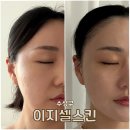 셀 스킨케어 | 수성구피부관리 받고 얼굴 열감까지 싹 잡은 이지셀스킨 리얼 후기