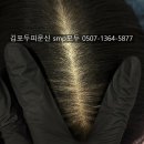 타코비비어(김포운양점) | 김포구래동 얇은모발 두피문신후기