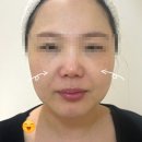 수안역 | 부산 수안역 올타이트리프팅 팔자 삭제 후기