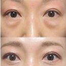 메디-1000(Medi-1000) | 눈밑지방재배치 수술 없이 눈밑 차오름? 대체 루틴 정리