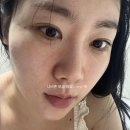 오랑 | 셀르디엠 후기 2주 (리투오랑 뭐가 다를까? 효과, 모공, 통증 비교)