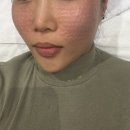 퓨전 | 강남 힐퓨전 리쥬란힐러 후기 | 겨울 각질·건조 피부 장벽 복구 리얼 변화