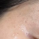 성지빌딩 화장실 | 편평사마귀 성지| 청량리 자연튼튼의원 예약후기/시술 후기(내돈내산O, 예약꿀팁)