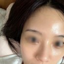 눈밑지방재배치레이저 효과 직빵인 강남피부과 루엘프팅 솔직 후기