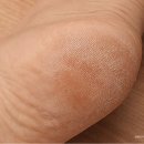 발뒤꿈치 까짐 쉽게 관리하는 법