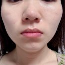 튠페이스 내돈내산 부작용 걱정없는 타임락튠으로 탄력 리프팅 후기