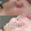 로마광광나이트 | 세로 모공 관리 줄이는법 코모공 축소 쪼일수 있나요