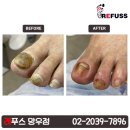 레푸스 망우점 | 두꺼워진 발톱. 스케일링 후기 [레푸스 망우점]