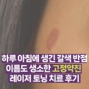 약진약국 | [레이저토닝 후기] 약 알레르기 때문에 얼굴에 갈색...이름도 생소한 &#39;고정약진&#39; 내돈내산 치료기 - 1